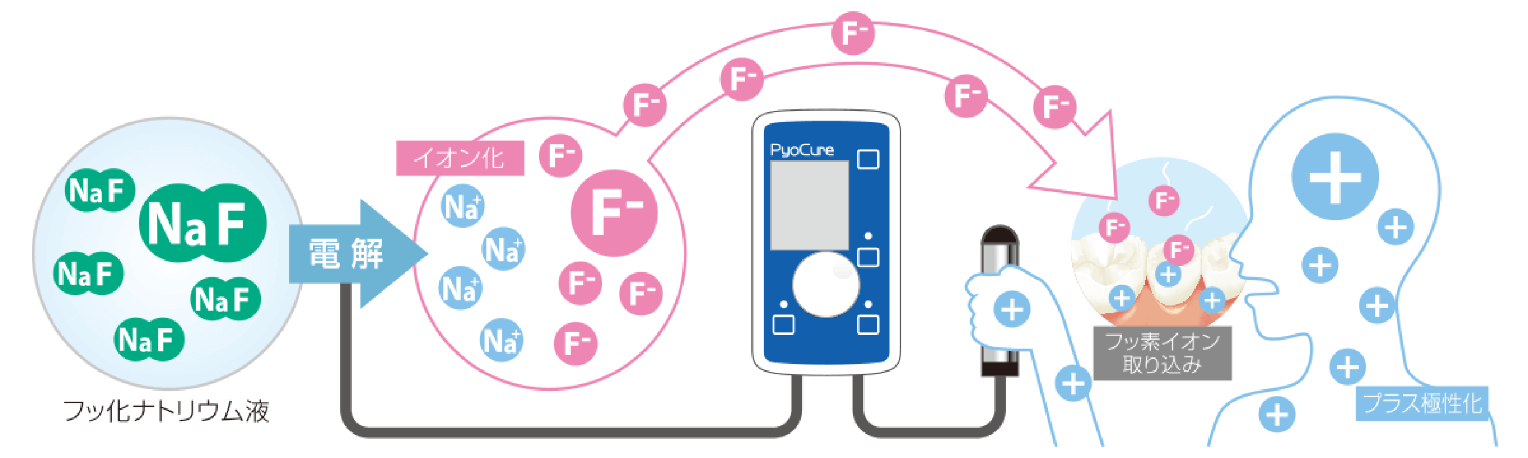 フッ素イオン導入法の仕組み